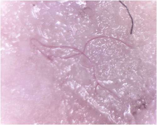 Цианобактерии, вызывающие болезнь Моргеллонов, фото фотография