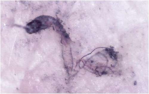 Morgellons disease photo