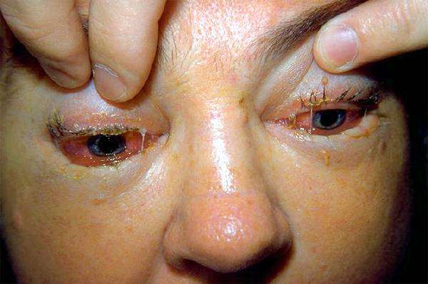 Поражение конъюнктивы глаз человека трихинеллой, фото болезни животных человека фотография